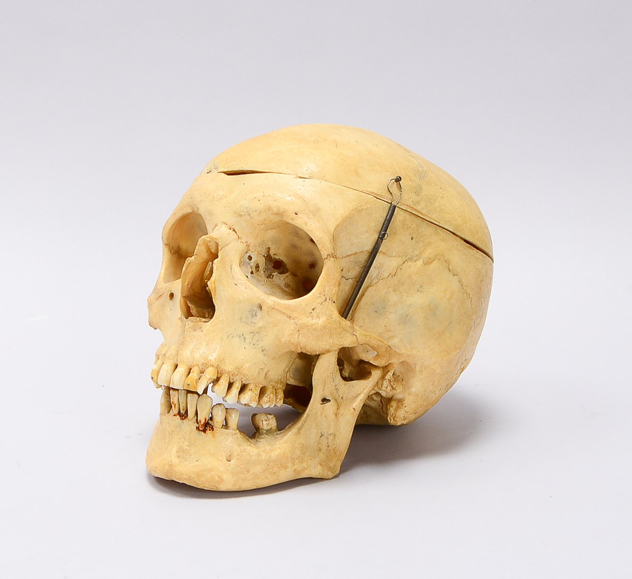 Medizinischer Todenschädel, beweglicher Unterkiefer, abnehmbare Schädeldecke; Höhe 16 cm